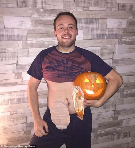 People Show Off Their Stoma Bags For A Charity Calendar With Images