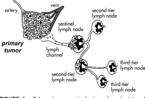 Figure 1 From Radioguided Sentinel Lymph Node Biopsy In Breast Cancer Surgery Semantic Scholar