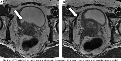 Figure 1 From Prostate Cancer With Nodular Bladder Invasion Stage T4N1