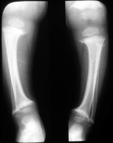 Xombor notes: Be careful with the disease rickets