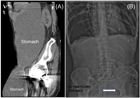 Jcm Free Full Text Gastric Outlet Obstruction From Stomach Containing Groin Hernias Case