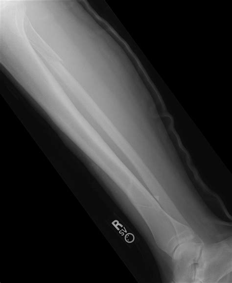 Broken Leg XraySeries 2 Free Photo Download | FreeImages