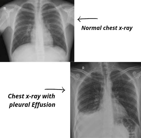 Pleural Effusion Signs And Symptoms