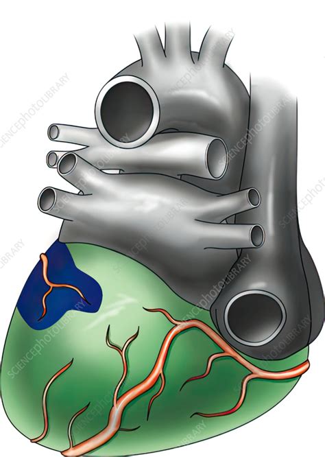 Heart showing area of infarction, illustration - Stock Image - C059/3305 - Science Photo Library