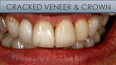 Replacing A Cracked Veneer Crown Youtube