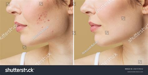 Young Woman Before After Acne Treatment Stock Photo 2067579032 ...