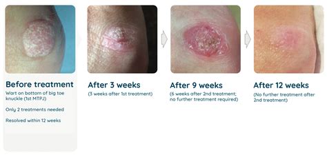 Wart Removal Treatment | How To Get Rid Of Warts | Geelong Wart Clinic