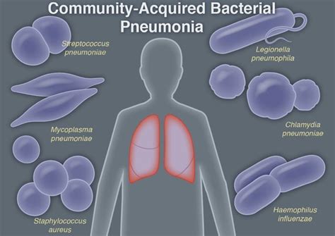 Pneumonia bacteriana: sintomas e tratamento - Tua Saúde