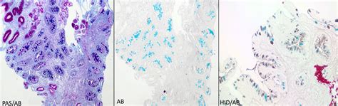 Pathology Outlines Intestinal Metaplasia