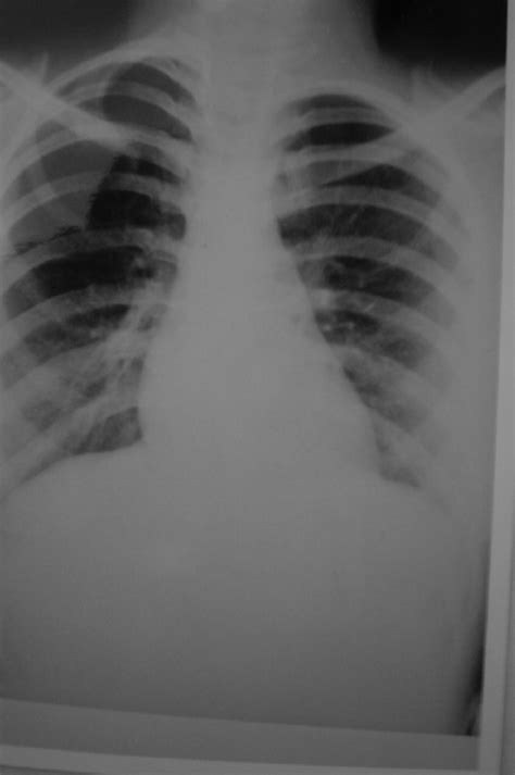 The Resection Of The Cervical Rib With The First Rib Download Scientific Diagram