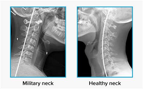military neck  cervical kyphosis