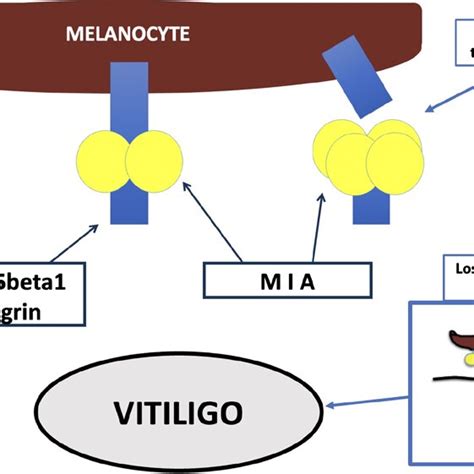 Scheme Of The Pathogenesis Of Vitiligo Induced By Mia Melanoma