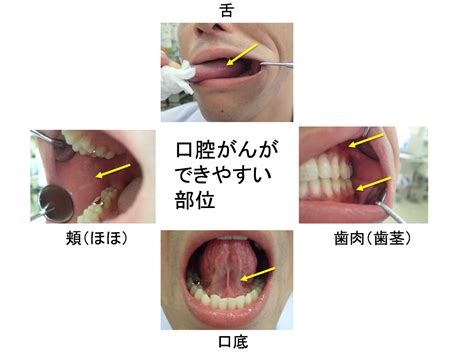 歯茎 癌 症状 Hello Doctor