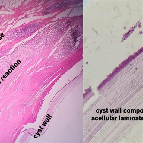 Cyst Wall Composed Of Acellular Laminated Layers And Fibrous Tissue Download Scientific