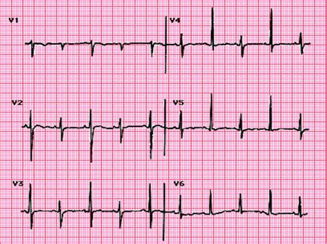 Ecg Pericarditis