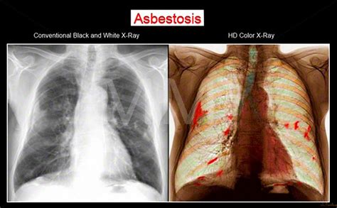 Asbestos Asbestosis Pictures