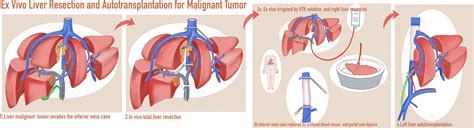 Frontiers In Vivo Total Or Partial Hepatectomy Followed By Ex Vivo