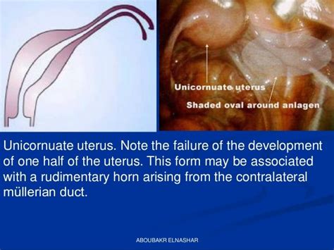 Mullerian Duct Anomalies