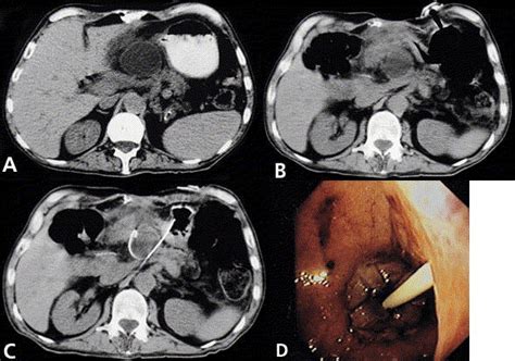 First Clinical Application Of A Newly Developed Device For Intragastric