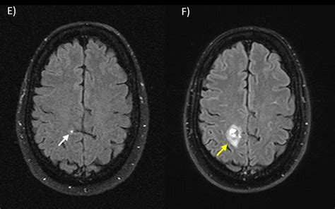 E) Magnetic resonance imaging (MRI) of the brain five months after ...