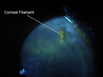 H16.121-123 Filamentary Keratitis - Decision-Maker PLUS