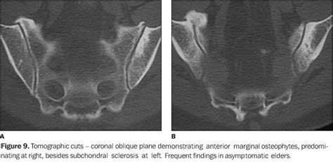 Mri Sacroiliitis