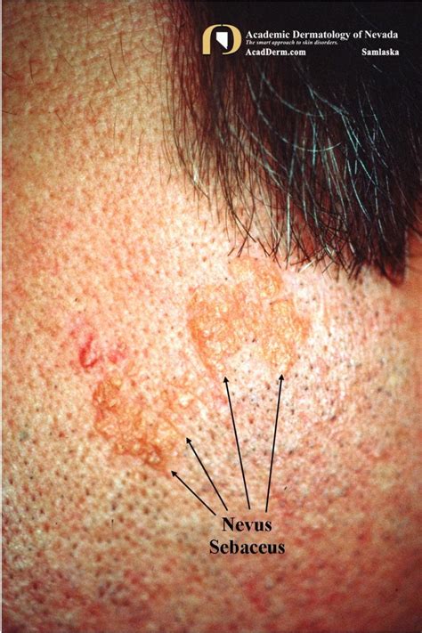 Nevus Sebaceus Of Jadassohn Academic Dermatology Of Nevada