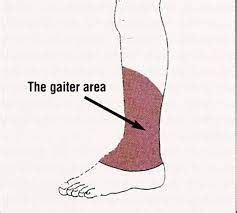 Health Ass Tres Flashcards Quizlet