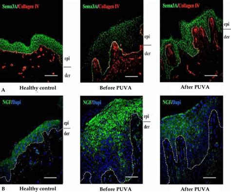 A Presence Of Semaphorin 3A Marked In Green In The Normal Skin 1