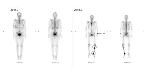 Bone scan findings during treatment. The initial bone scan image ...