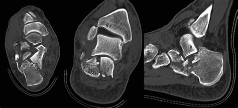 Calcaneus Fractures Musculoskeletal Key