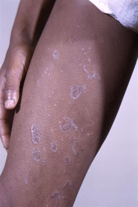 Lichen Planus Skin Rash