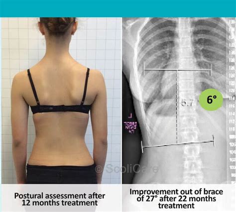 Scoliosis Brace Before And After