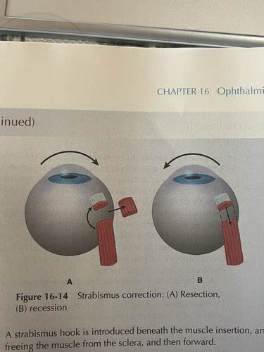 Ophthalmic Surgery Flashcards Quizlet