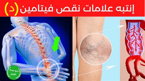 10 علامات وأعراض تحذيرية أنك تعاني من نقص فيتامين د إنتبه لهذه