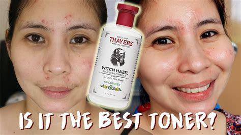 Thayers Witch Hazel Toner For Acne Witch Hazel For Acne The Complete