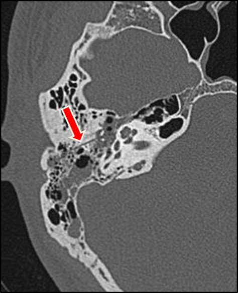 Radiopaedia case Longitudinal temporal bone fracture id: 49362 study: 54475 - NC Commons