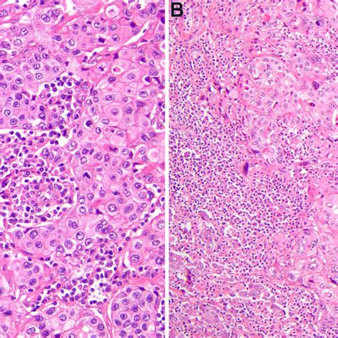 Thymic Squamous Cell Carcinoma Different Varieties Of Thymic Squamous