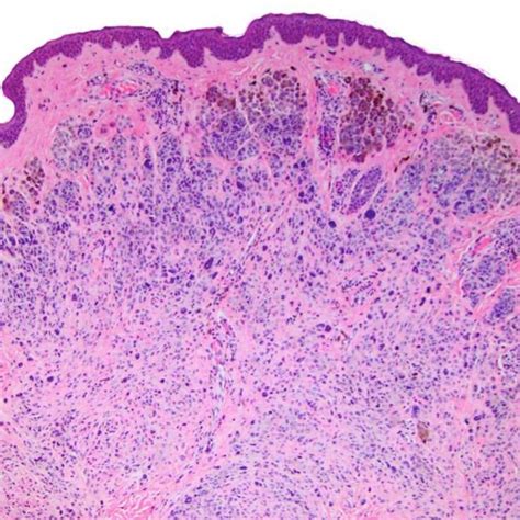 Pdf The Spectrum Of Melanocytic Lesions From Examples To Biologically Relevant Conditions