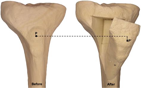 A New Technique For Distalization Of The Tibial Tubercle That Allows