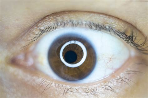 Understanding Eye Discharge: Causes, Symptoms, and Treatment - World ...