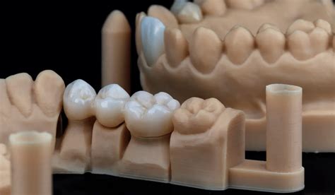 What Is A Dental Bridge Types And Benefits