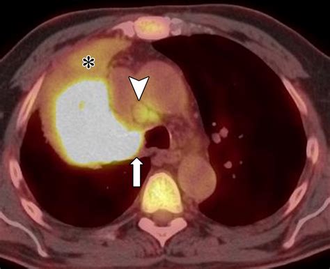 Role Of Fdg Pet Ct In The Eighth Edition Of Tnm Staging Of Nonsmall