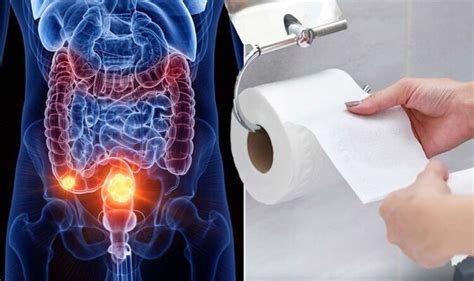 Bowel cancer: ‘First’ signs include blood mixed in with stool and