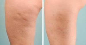 Rimedi Naturali Per Eliminare La Cellulite Donne Mag