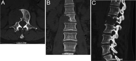 Leiomyosarcoma Metastases To The Spine In Journal Of Neurosurgery