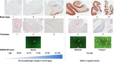 The Spectrum Of Alzheimer Type Pathology In Cognitively Normal