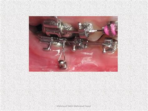 Orthodontic Appliances Ppt