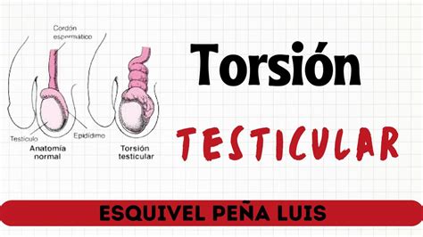 Torsi N Testicular Luis Esquivel Pe A Udocz