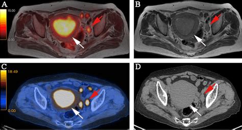 Figo Stage Iiic1 Pathologically Confirmed Moderately Differentiated